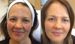 A before and after photo of a woman 's face.