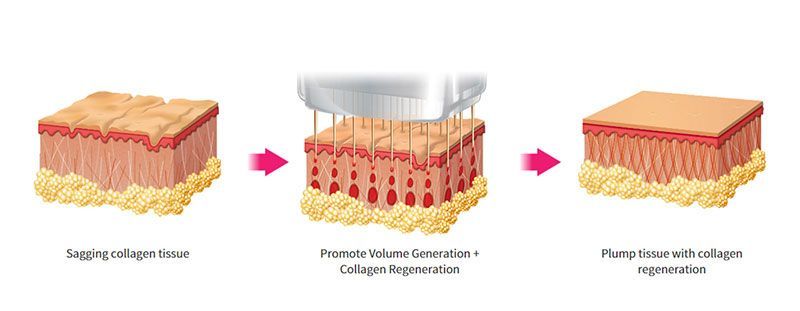 A diagram showing the process of making collagen in the skin.