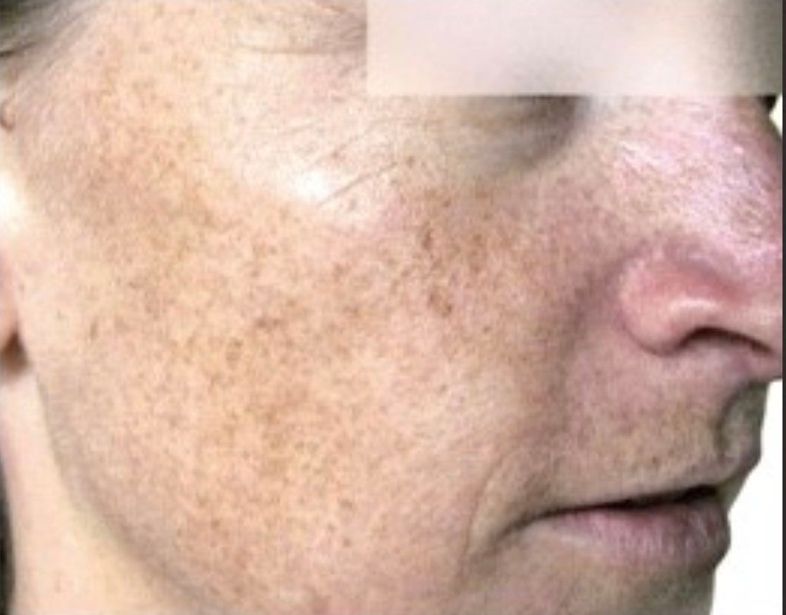 A close up of a woman 's face with freckles