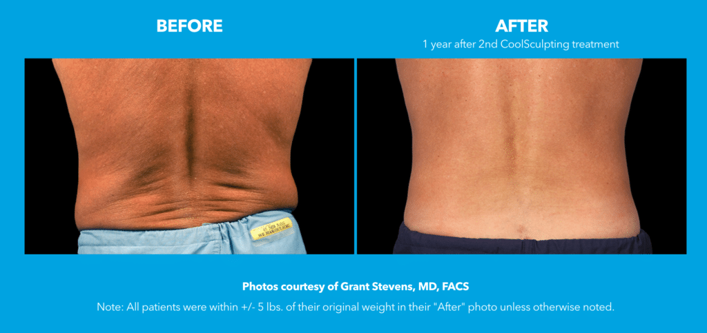 A before and after picture of a man 's back.