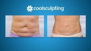 A woman 's stomach before and after a coolsculpting treatment.
