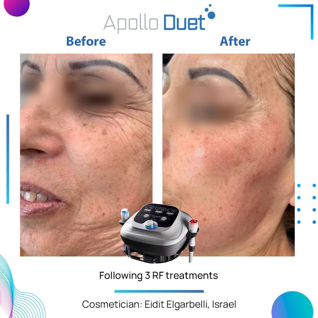 Ein Vorher-Nachher-Foto vom Gesicht einer Frau