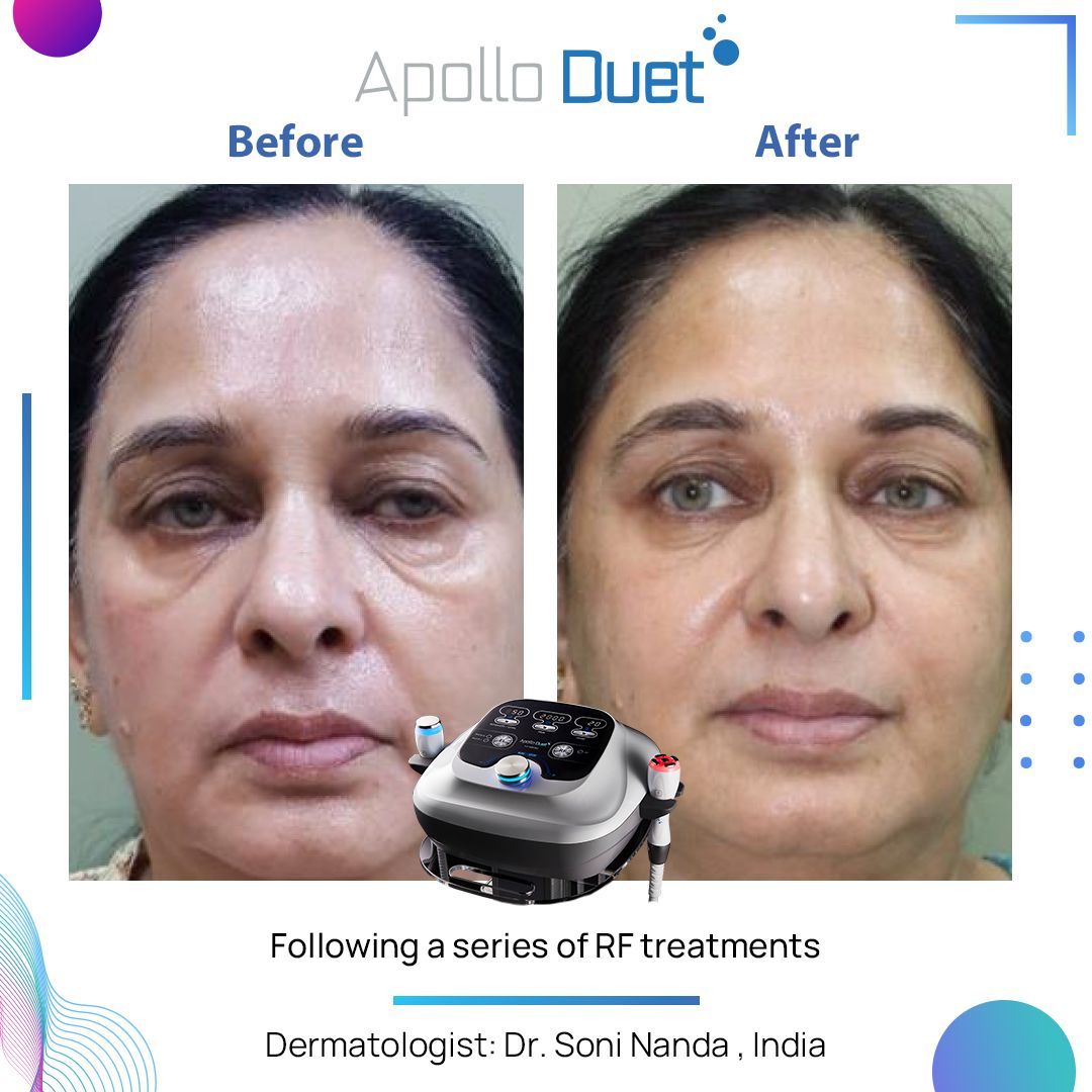 Ein Vorher-Nachher-Foto vom Gesicht einer Frau