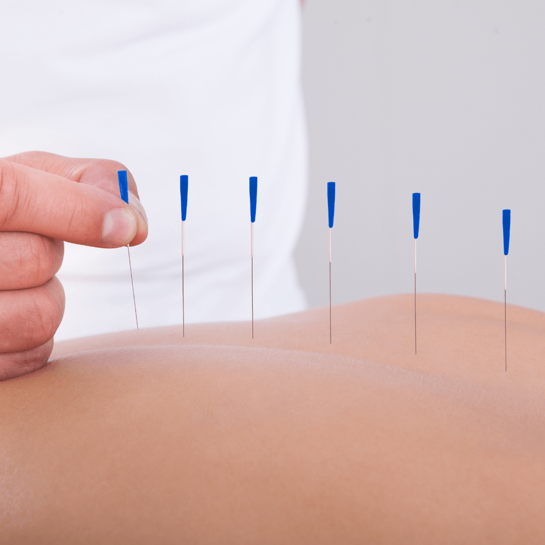 A person is getting acupuncture on their back.