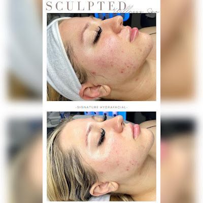 Before and after photos of a person's face. Shows acne before and smoother skin after a