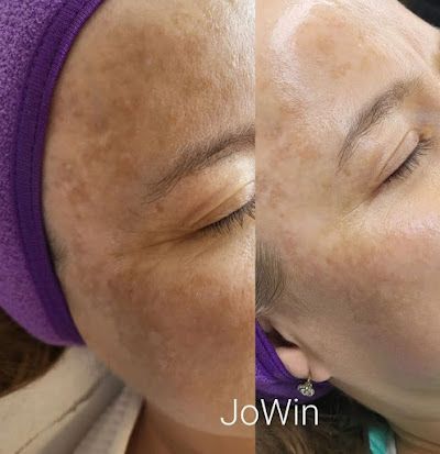 Side-by-side view of a face before and after skin treatment, showing reduced brown spots and improved skin tone.