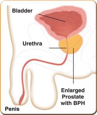 Enlarged Prostate — Hickory, NC — Viewmont Urology Clinic, PA