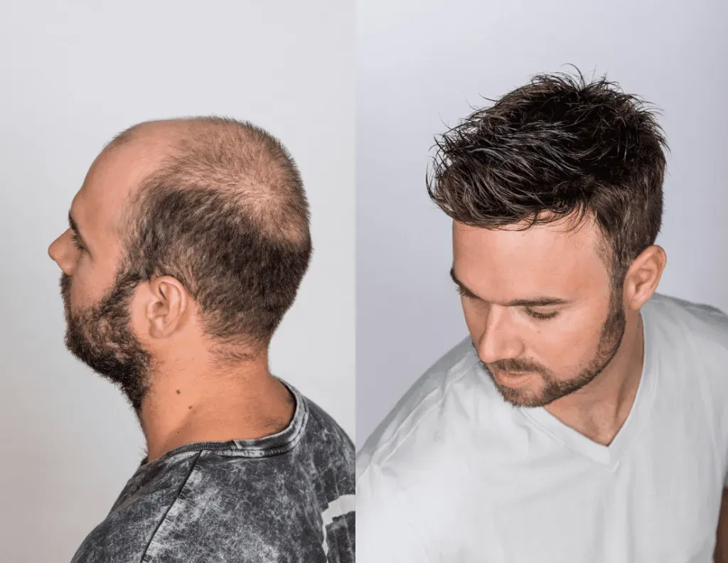 Man with thinning hair before and after a hair restoration.