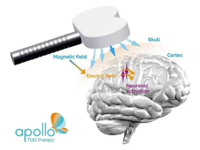 Diagram showing TMS therapy: device emits a magnetic field that activates neurons in the brain cortex.