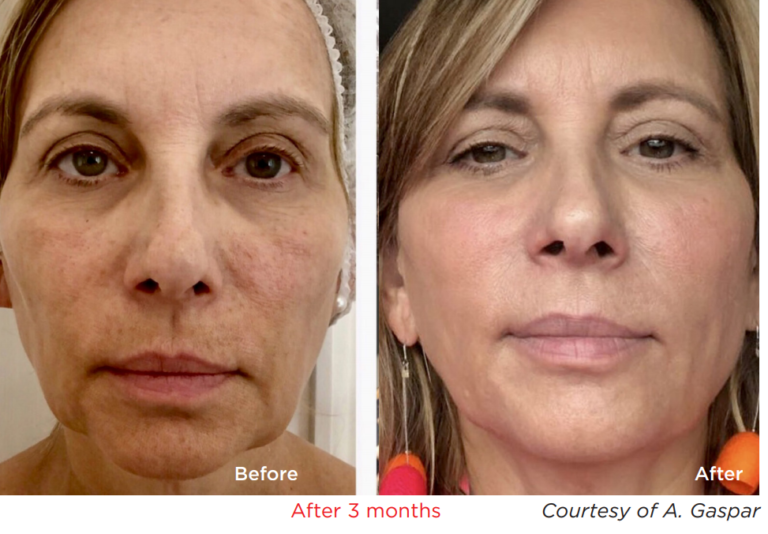 voor en na Fotona 4D behandeling voor huidverjonging. Haar en Huid kliniek Tessenderlo voor België en Nederland