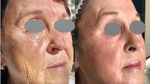 Fotona fractionele resurfacing haar en huid kliniek Tessenderlo laserpeeling huidherstel huidverjonging voor België en Nederland 22