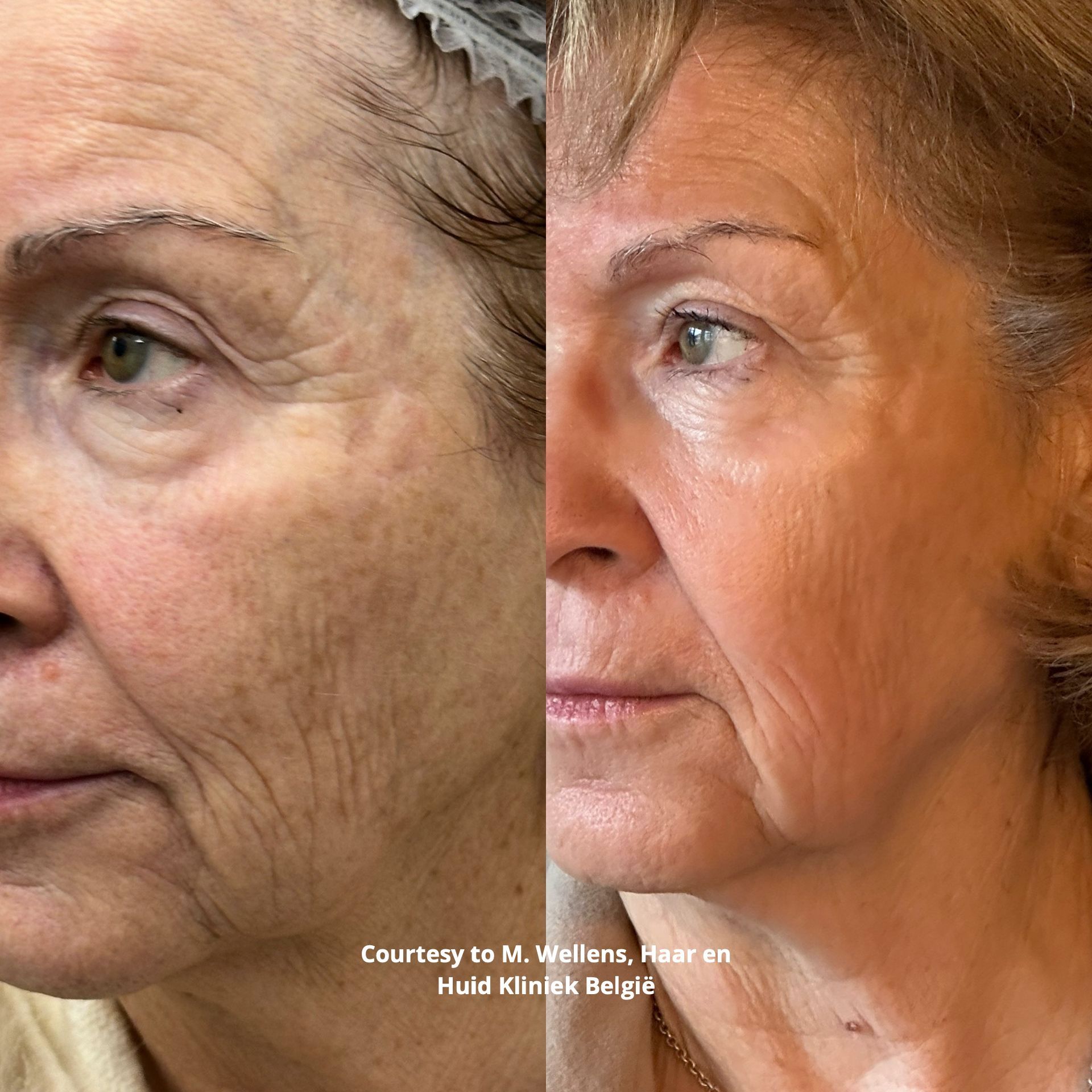 Fotona fractionele resurfacing haar en huid kliniek Tessenderlo laserpeeling huidherstel huidverjonging voor België en Nederland