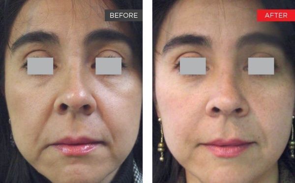 voor en na Fotona 4D behandeling voor huidverjonging. Haar en Huid kliniek Tessenderlo voor België en Nederland