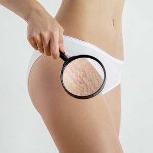 LineLaseTM is een procedure in 2 stappen die Fotona SMOOTH®-verstrakking combineert met ablatieve resurfacing. De eerste fase is ideaal voor huidverstrakking. De intense, gecontroleerde verwarming van het oppervlakteweefsel stimuleert de hermodellering van collageen en initieert neocollagenese. De effecten resulteren in een algehele verbetering van laxiteit en elasticiteit in de behandelde gebieden. De tweede fase bestaat uit huidablatie met een volledige of gedeeltelijke Er:YAG-straal, die de littekenkenmerken van striae verbetert en oppervlakkige imperfecties verwijdert.