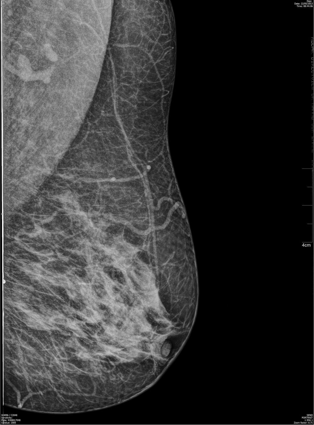 immagine mammografica
