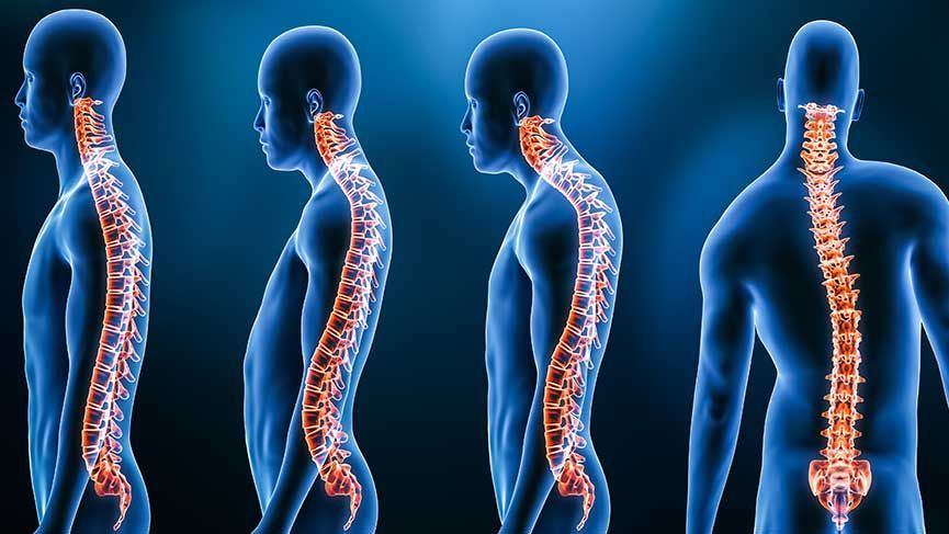 What Is Kyphosis Symptoms And Treatment