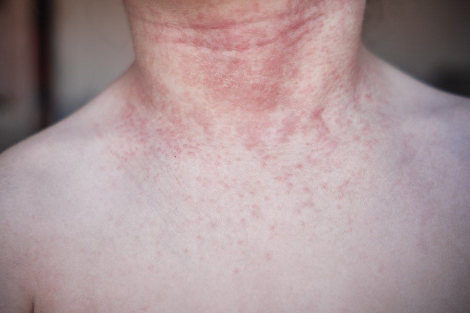 dermatite diagnosticata da allergologo a Como