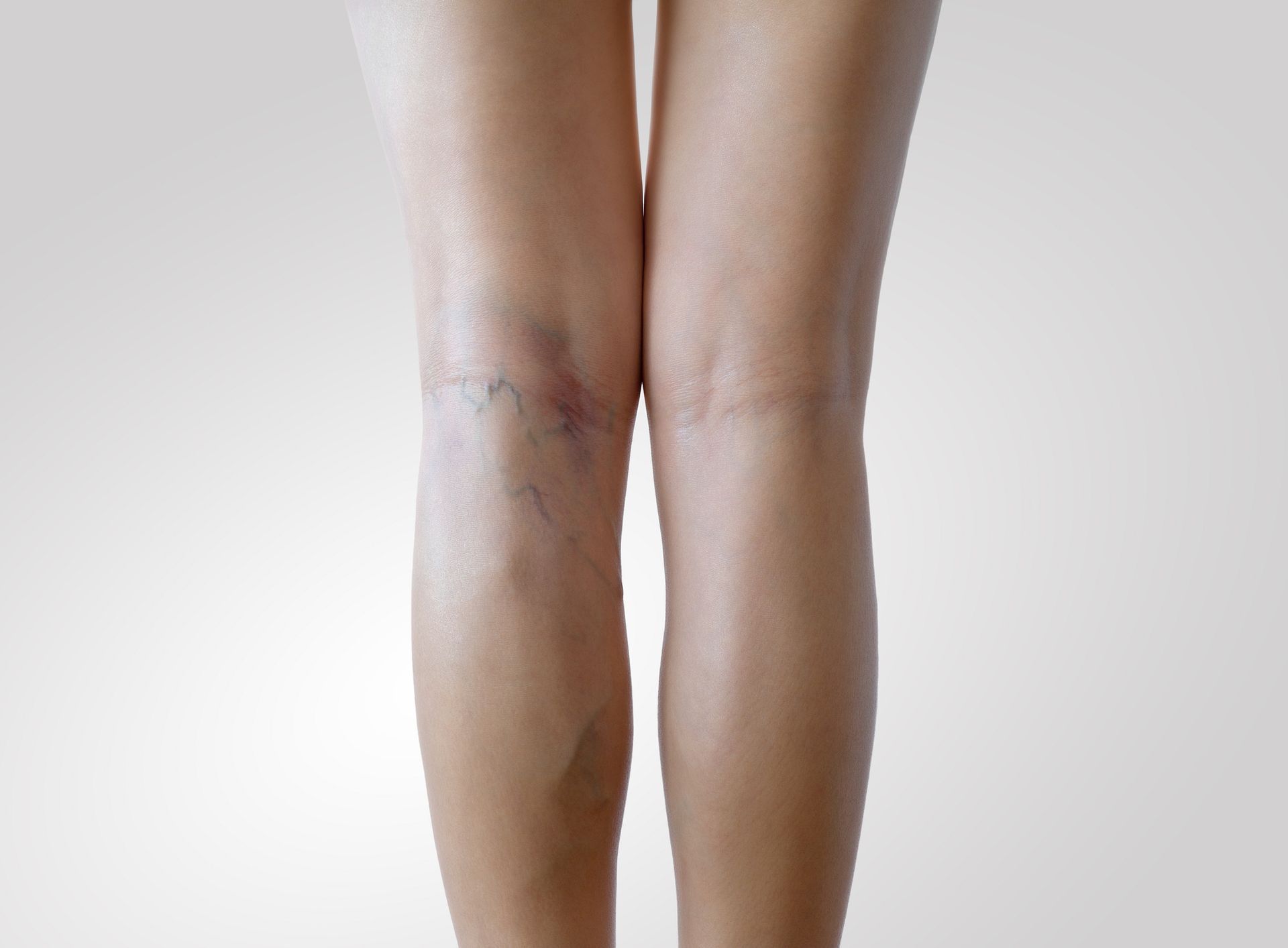 Close-up picture of a woman's legs with signs of varicose vein symptoms in one of them. 