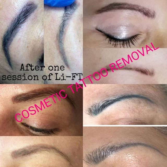 Face Forward Permanent Make Up, Laser Tattoo Removal, Aesthetics - Liverpool  - Book Online - Prices, Reviews, Photos