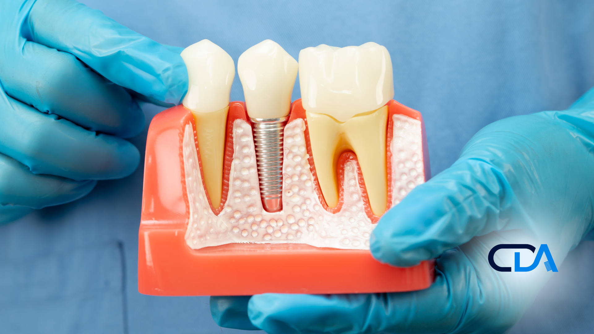 Hands in blue gloves holding a dental model showing a tooth implant between two natural teeth.