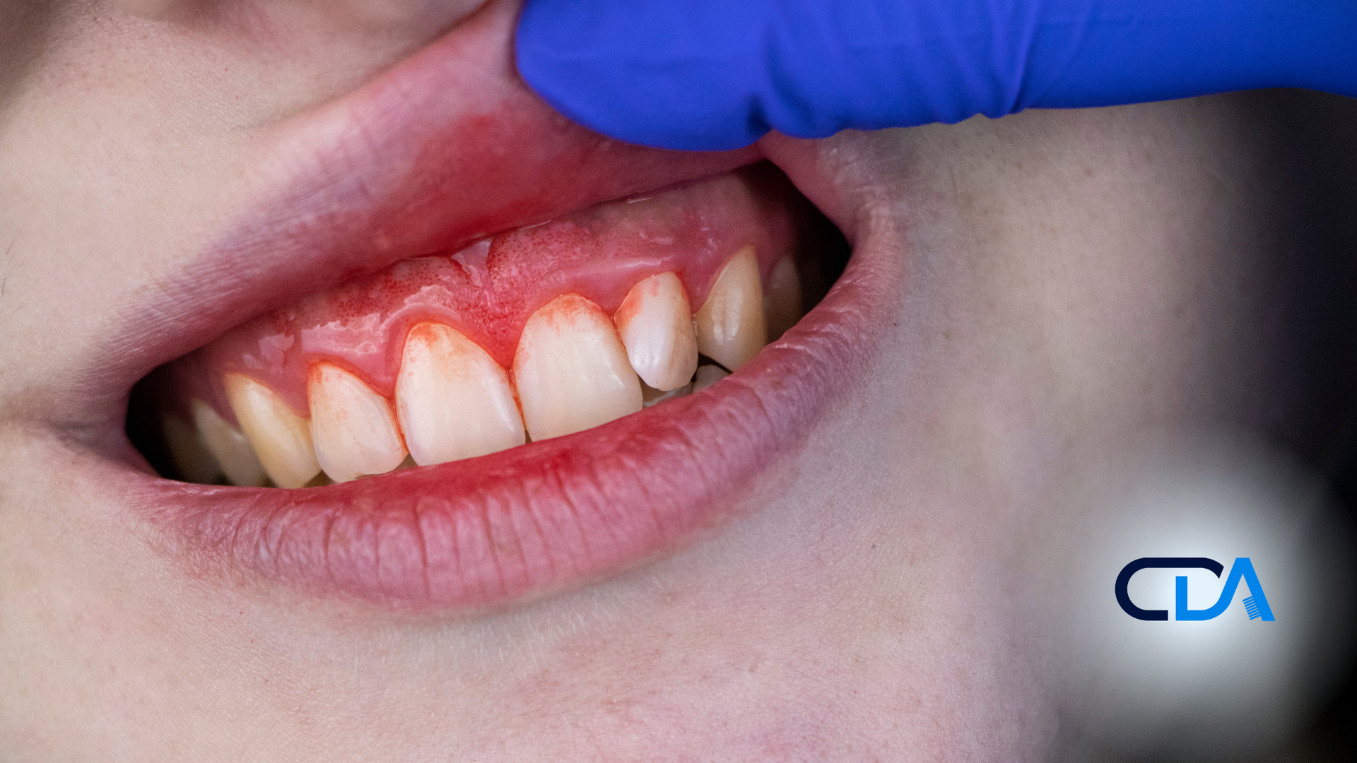 A close up of a person 's mouth with a blue glove on.