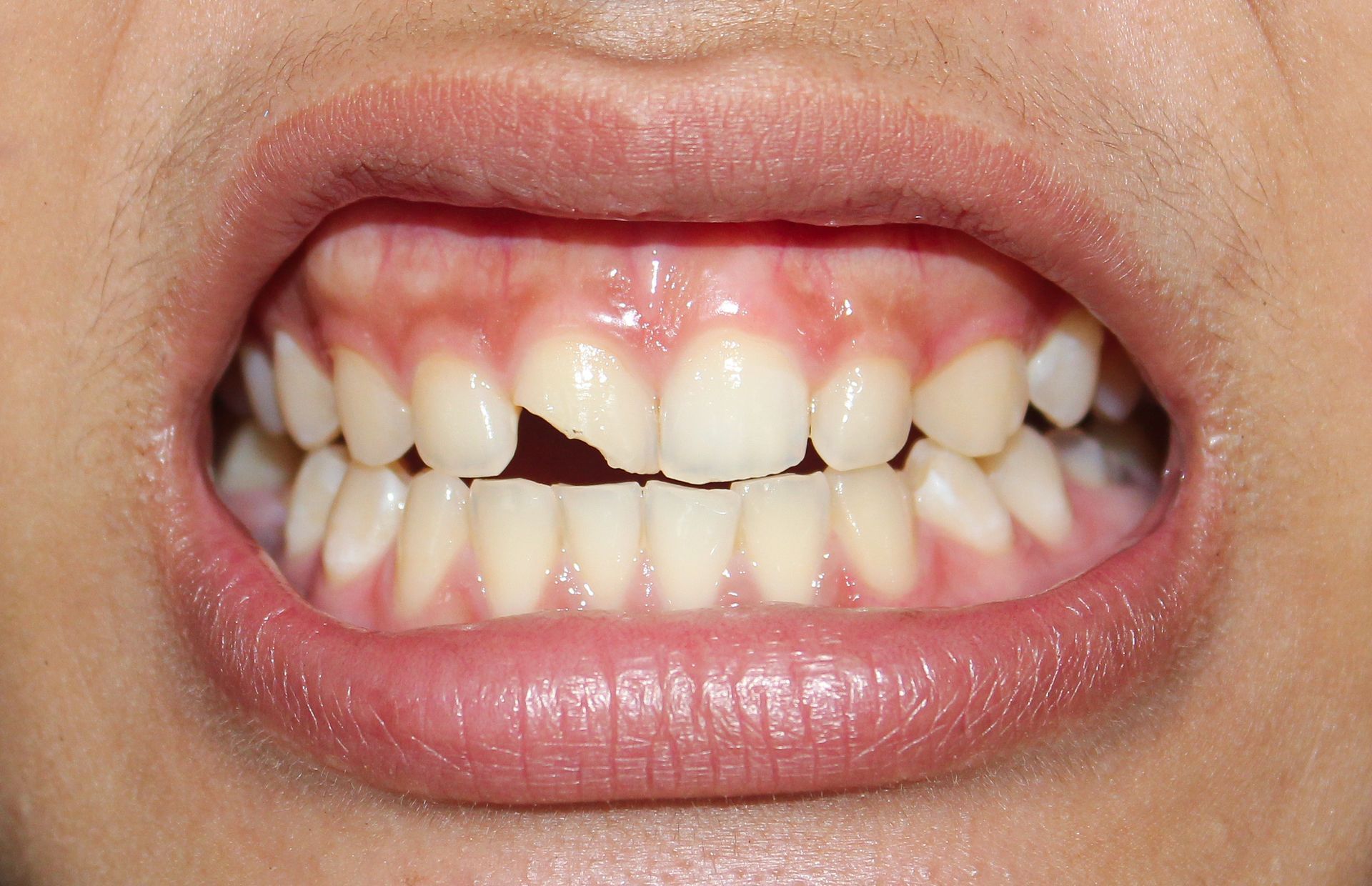 A gloved professional points to a specific area on a panoramic dental X-ray displayed on a screen.