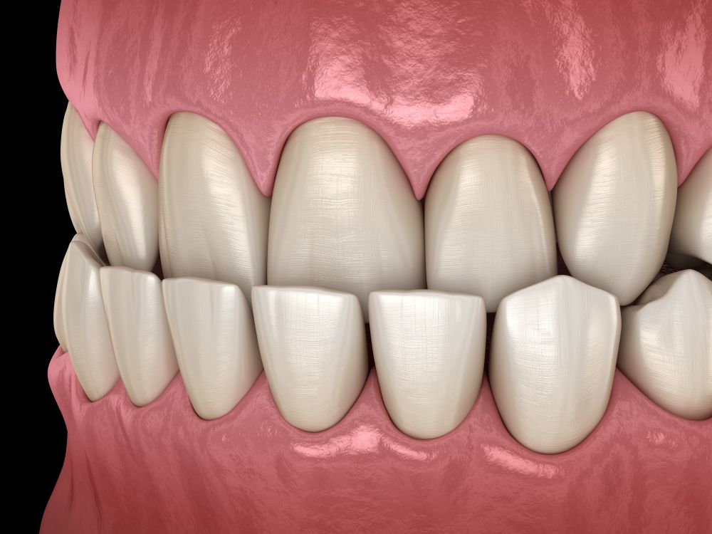 A gloved professional points to a specific area on a panoramic dental X-ray displayed on a screen.
