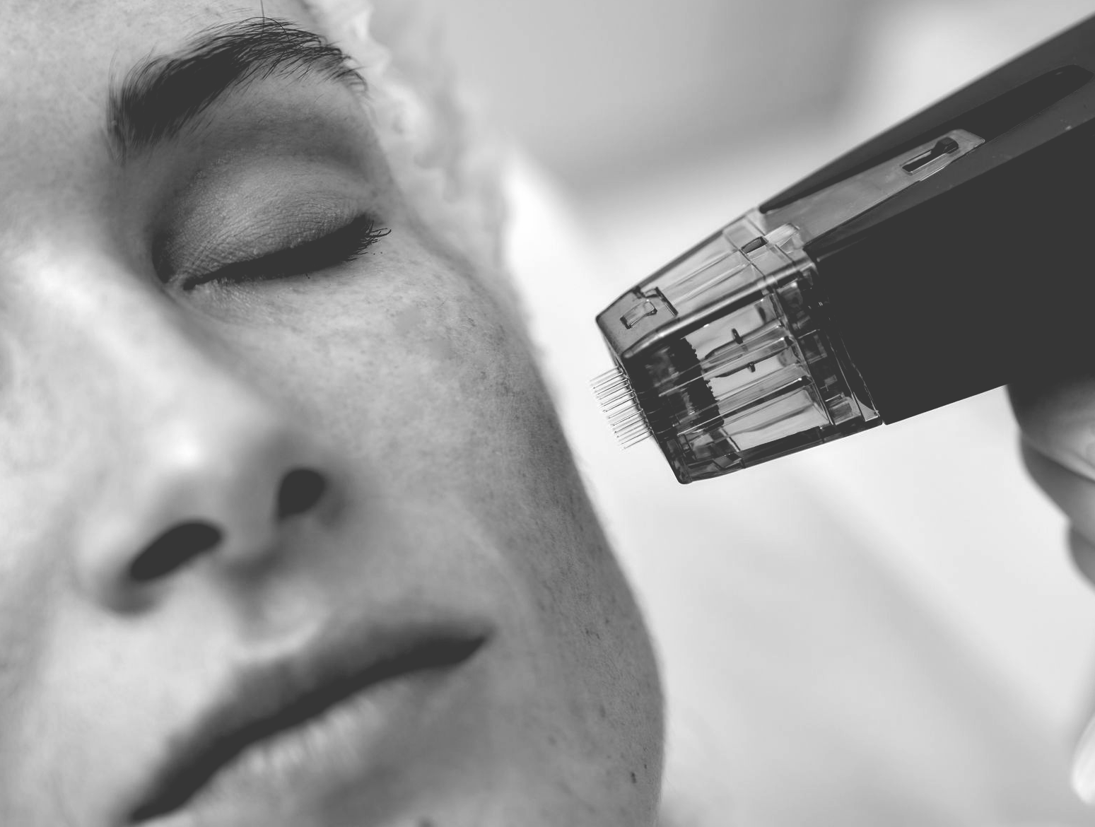 Person receiving micro-needling treatment on face; tool with needles close to skin.