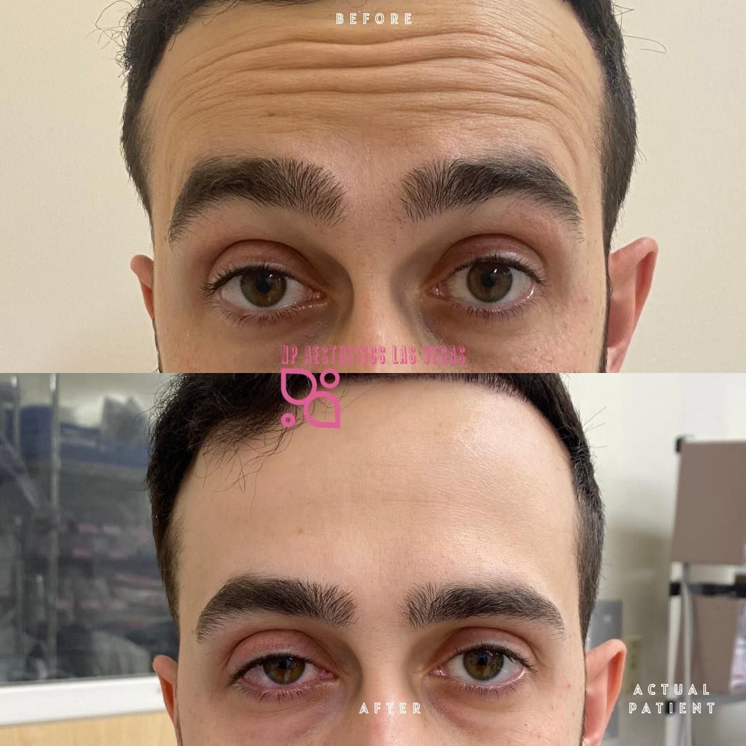 NP Aesthetics Las Vegas Before and After
