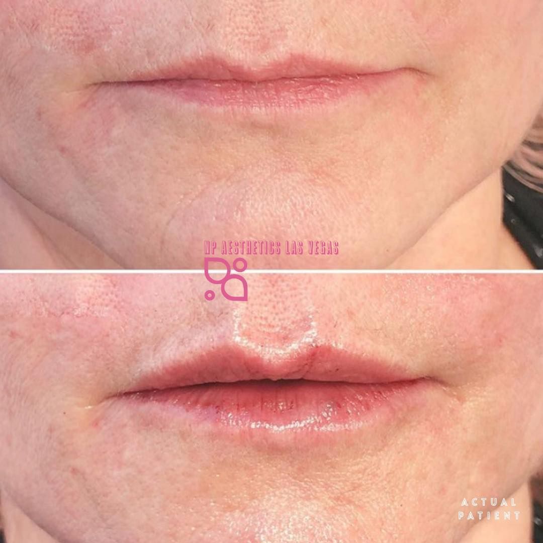 NP Aesthetics Las Vegas Before and After