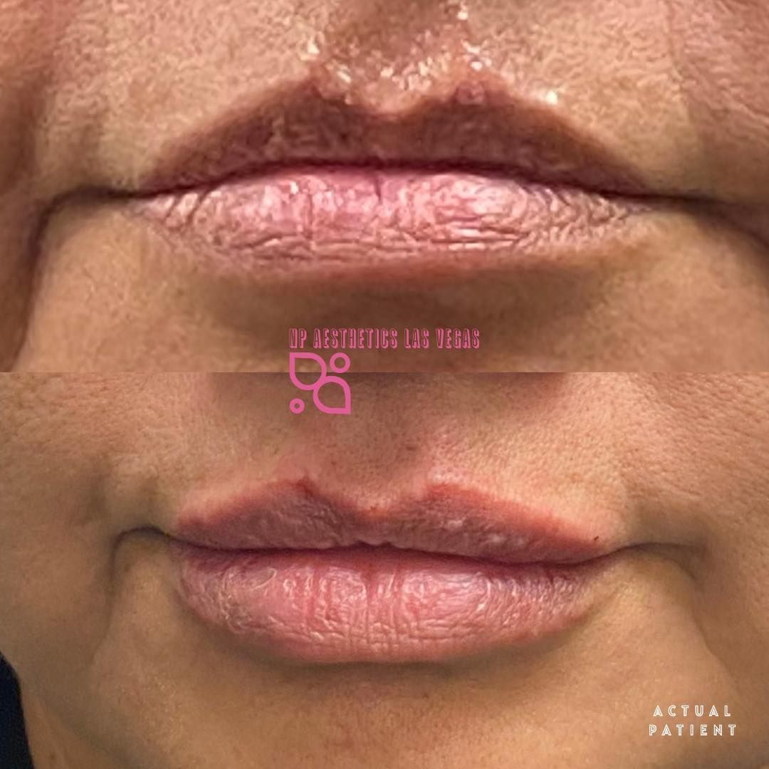 NP Aesthetics Las Vegas Before and After