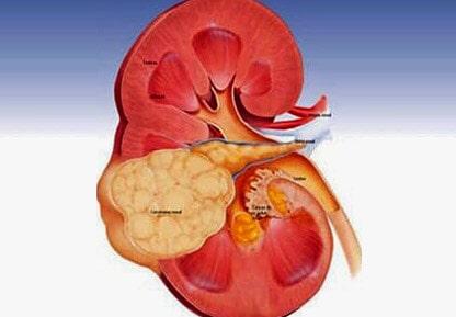 DR. ARTURO DANIEL JUÁREZ HERNÁNDEZ - LITIASIS RENAL