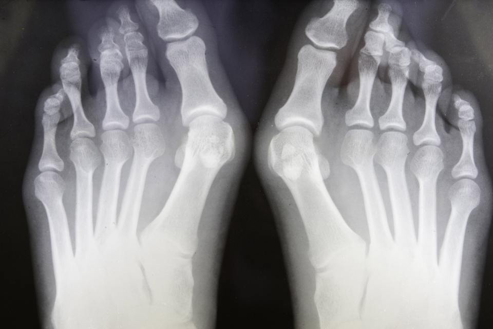 Foot surgery