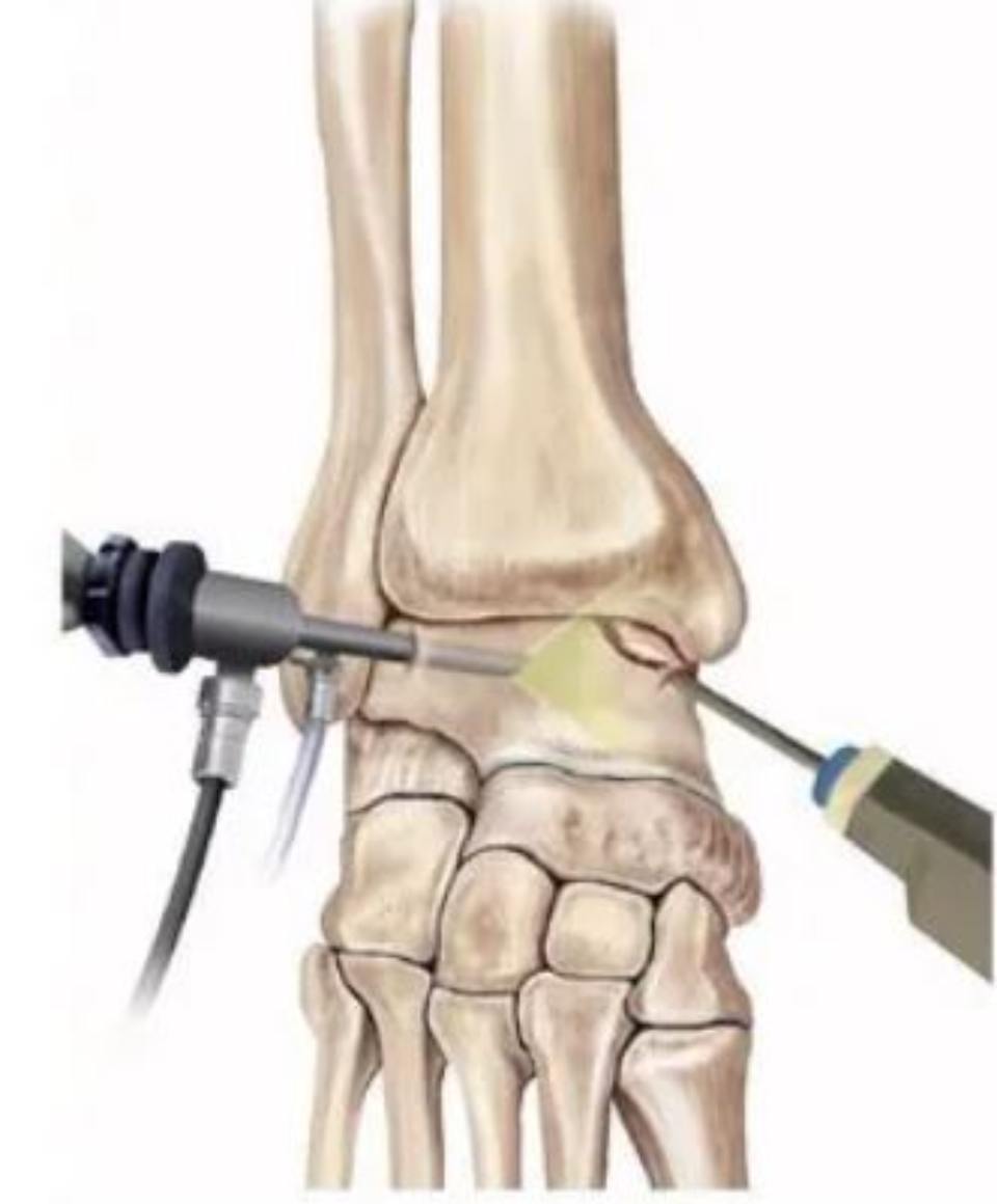 Ankle arthroscopy
