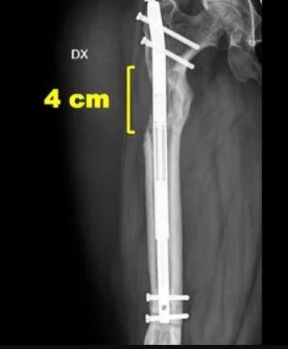 Limbs lengthening and deformity correction