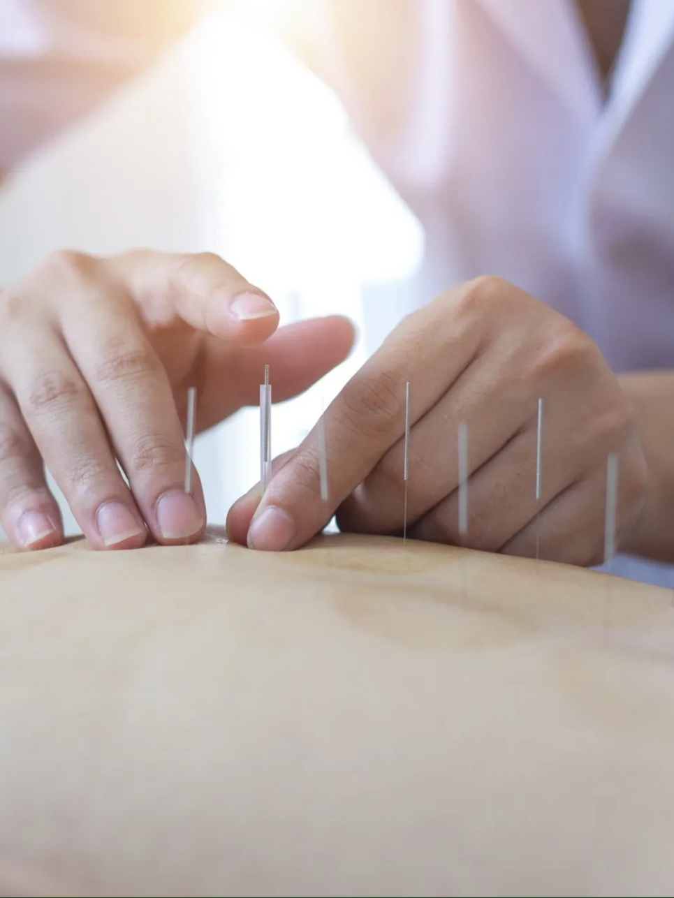 A person is getting acupuncture on their back at