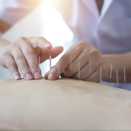 a person is getting acupuncture on their back
