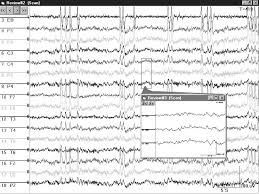 disturbi del sistema nervoso centrale