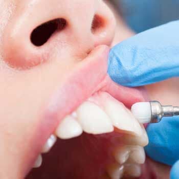 Teeth Polishing — whiter teeth in Chicago, IL