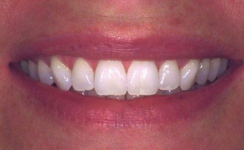 denti dopo sbiancamento professionale lampada led