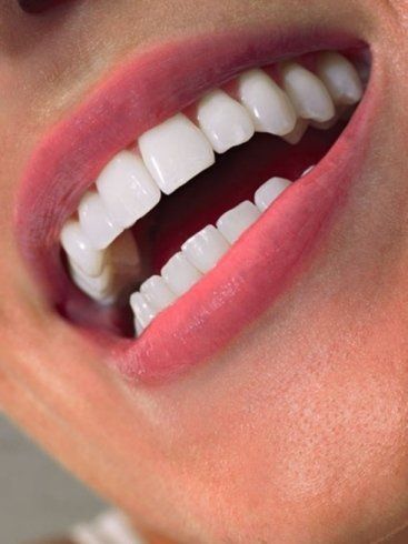 denti dopo sbiancamento a led