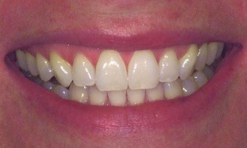 denti prima di sbiancamento