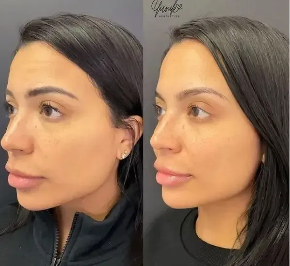 A Before and After Side View Look Photo of A Woman 's Face