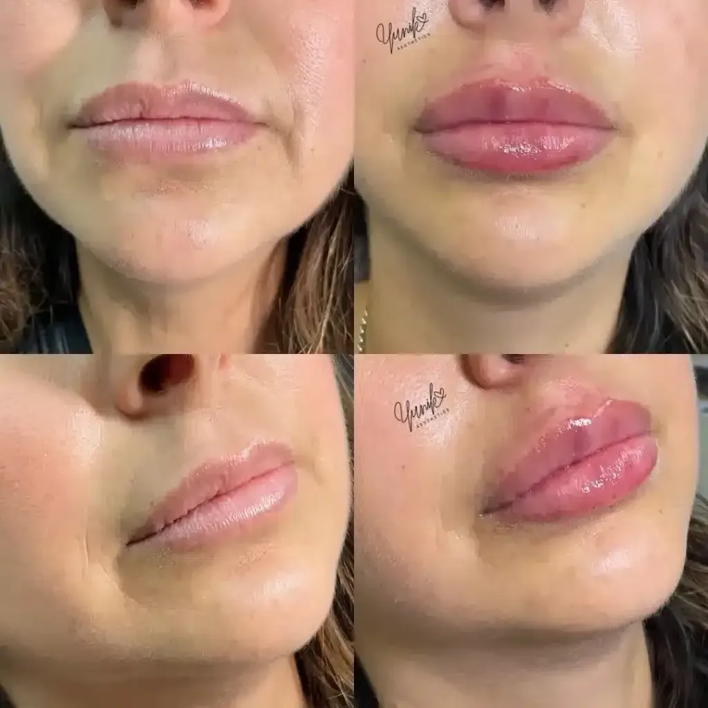 A Collage of Four Photos of A Woman 's Lips Before and After Lip Plastic Surgery.