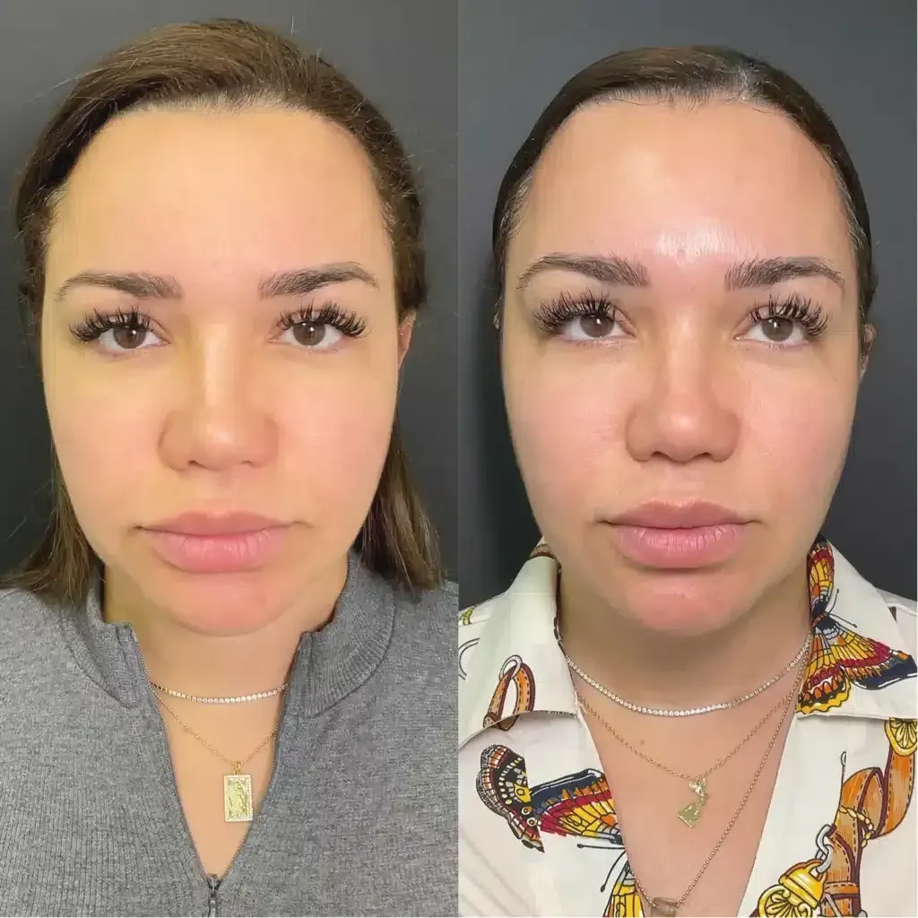 A Before and After Photo of A Woman 's Face Surgery.