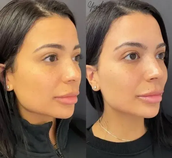A Before and After Photo of A Woman 's Face.