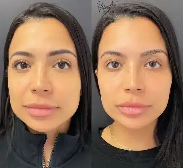 A Before and After Face Front Photo of A Woman 's Face.