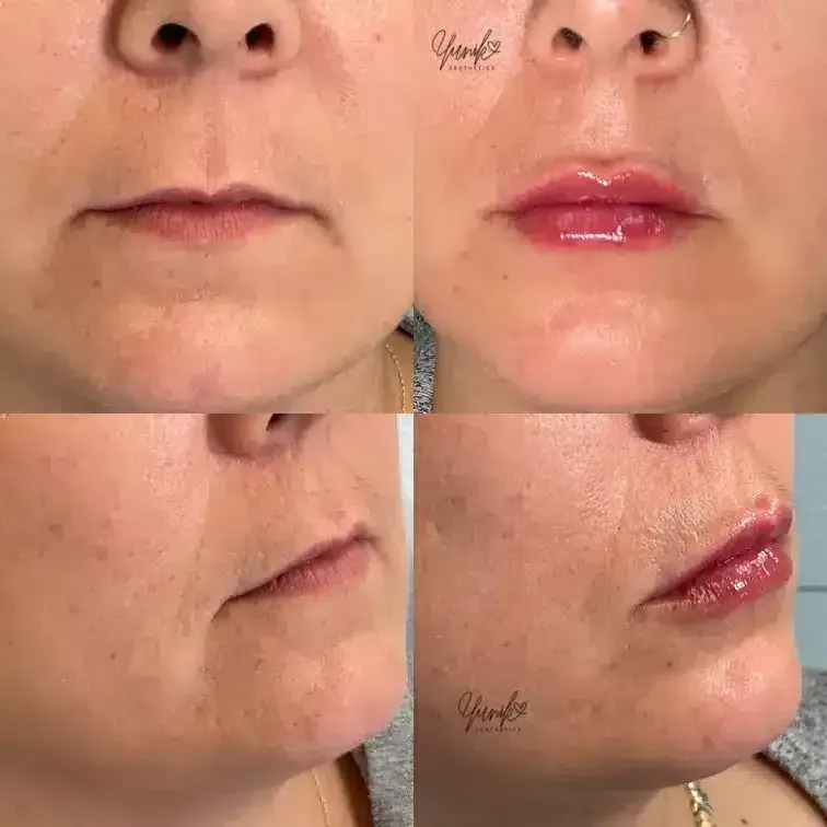 A Before and After Photo of A Woman 's Lips.