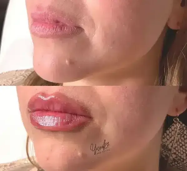 A Before and After Photo of A Woman 's Lips Enhancement.