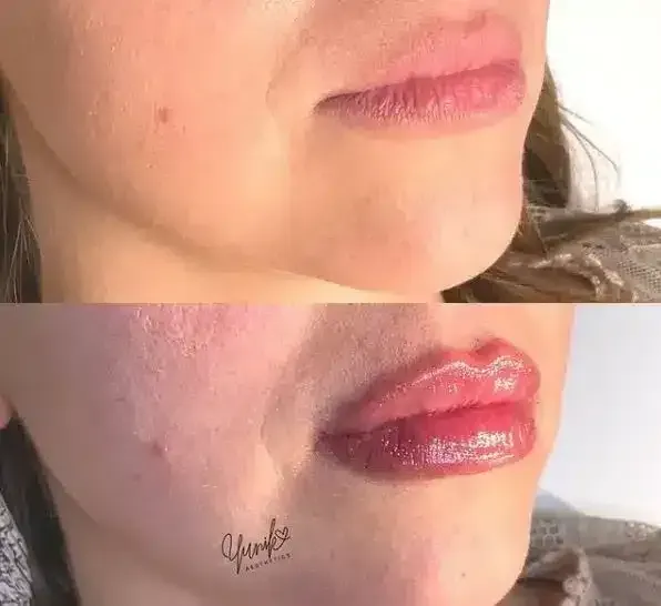 A Before and After Photo of A Woman 's Lips Operated.